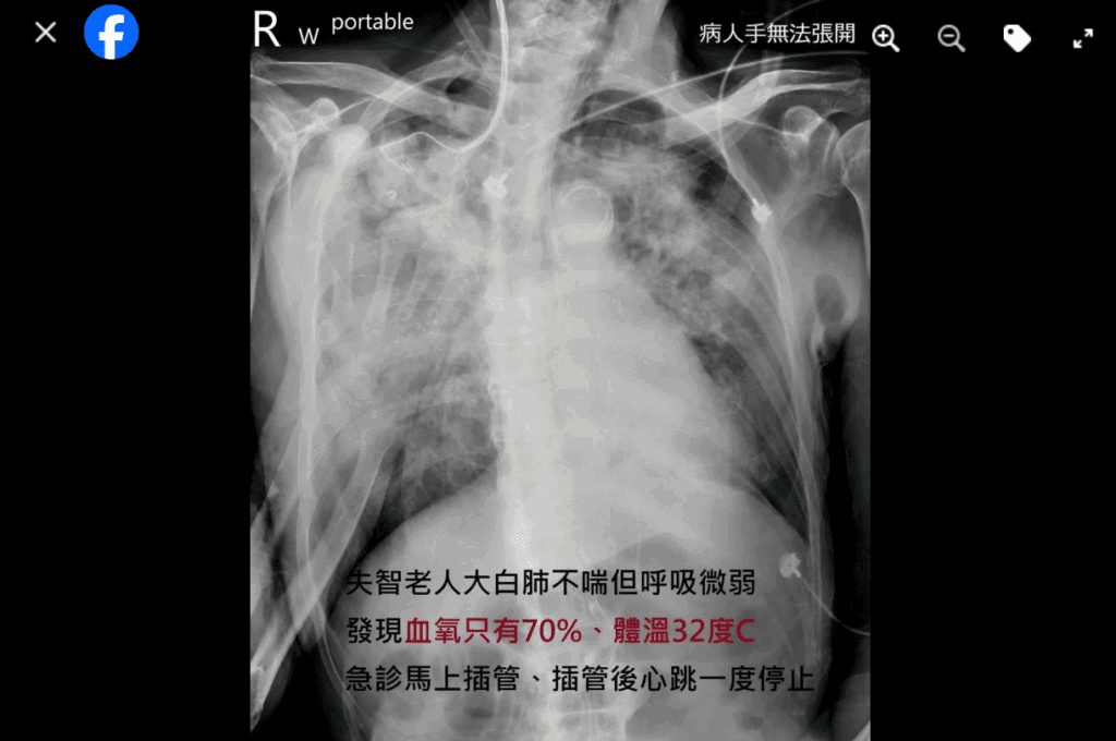 失智長者大白肺竟不喘 血氧低 經醫師發現快樂缺氧症狀